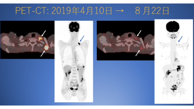 CMI3155-膵がん-PETCT-リンパメタ激減-